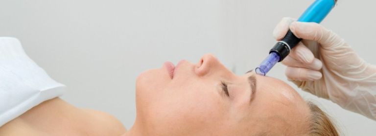Microneedling Treatment